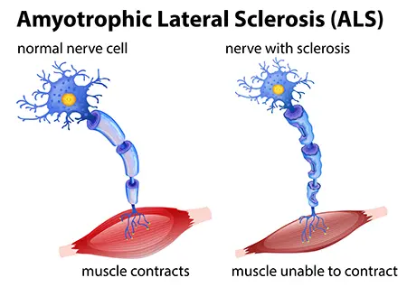 Amyotrophic lateral sclerosis concept
