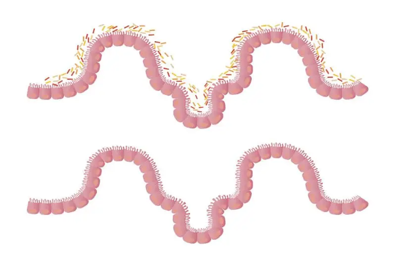 Transplant de Microbiotica Fecala (FMT)