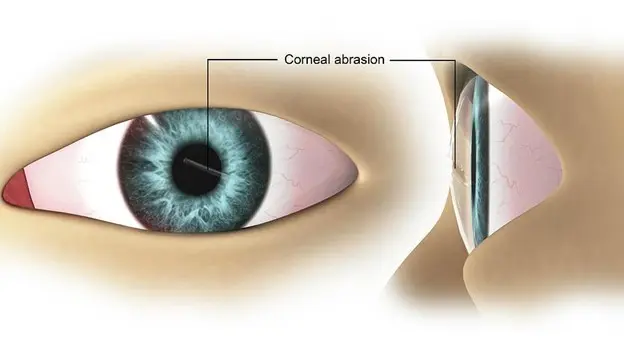 Corneal Damage